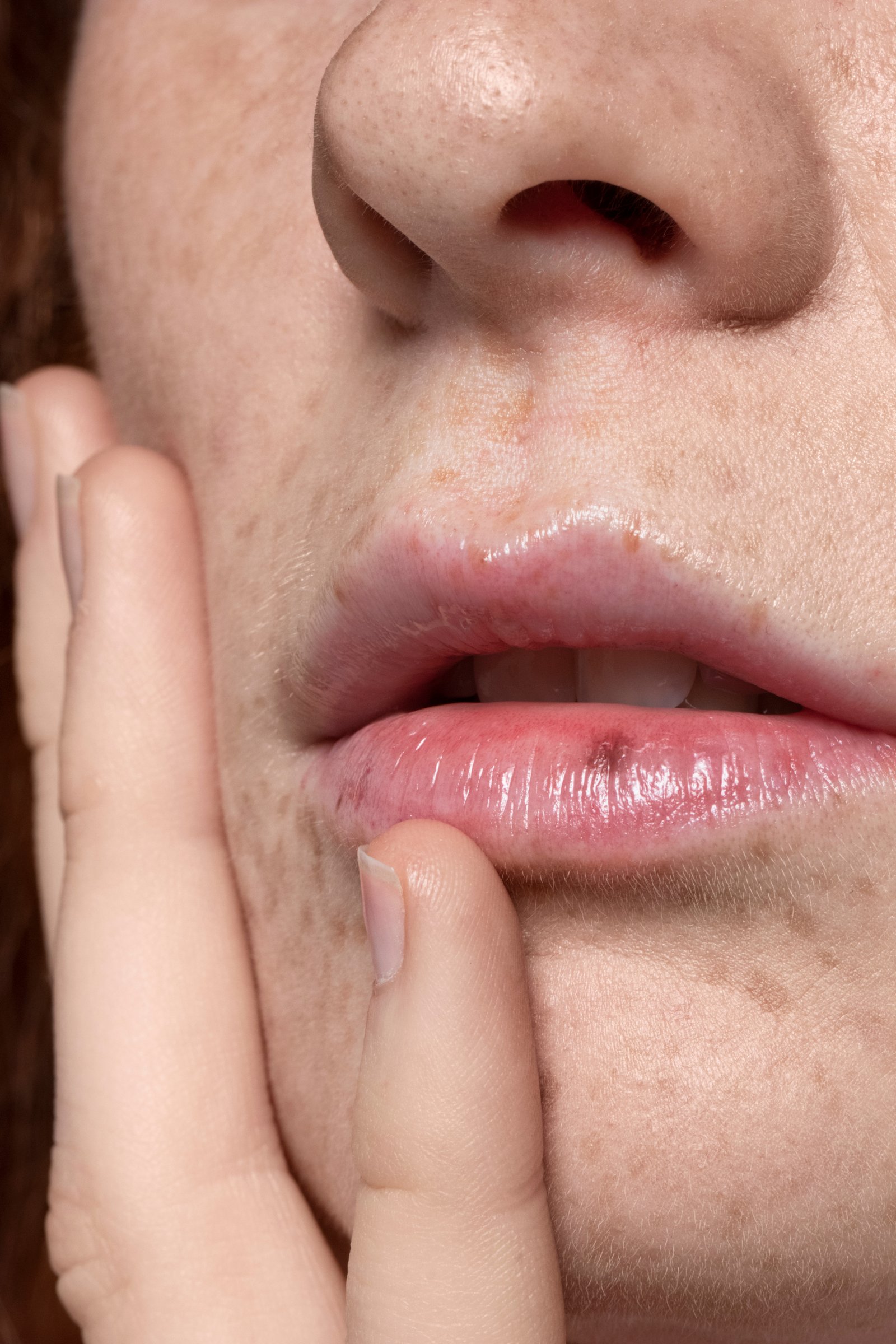 Specialist performing laser lip pigmentation treatment at Hues Aesthetic Clinic Madurai